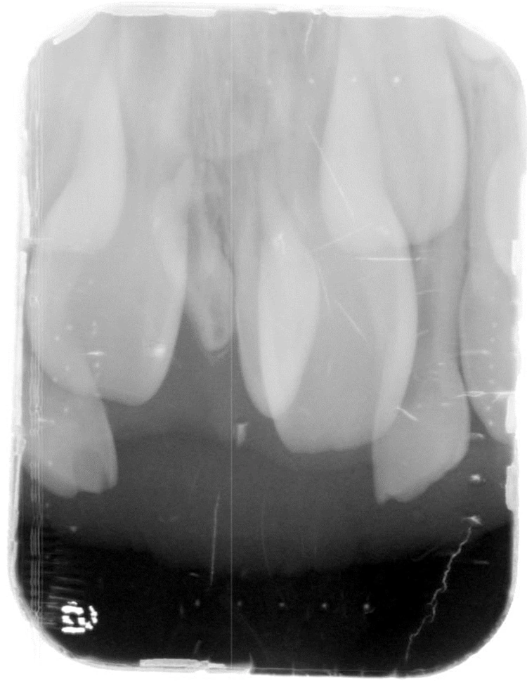 Case 2 Diagnoses Developing Mesiodens Radiographic Interpretations Dentalcare