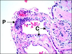 Case Challenge 28 - Content - Diagnostic Information - fig05-photomicrograph-high