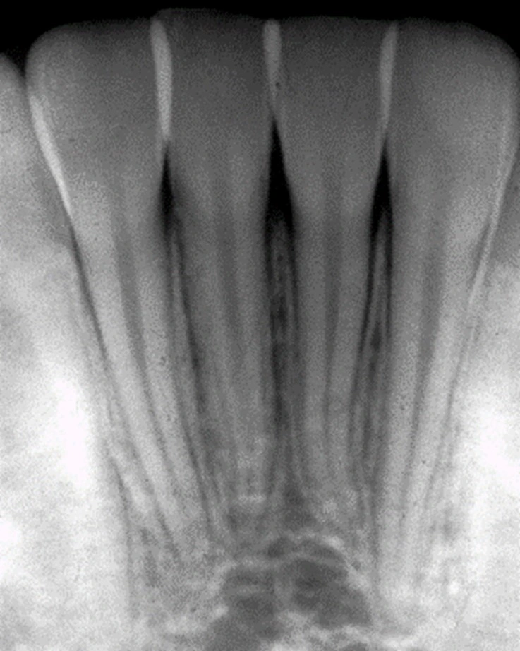 Normal Radiographic Appearance of the Supporting Structures of the ...