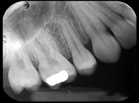 Radiograph showing the receptor not placed perpendicular to the occlusal plane for maxillary teeth.