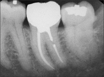 Periapical radiograph of #17 with a distal enamel pearl