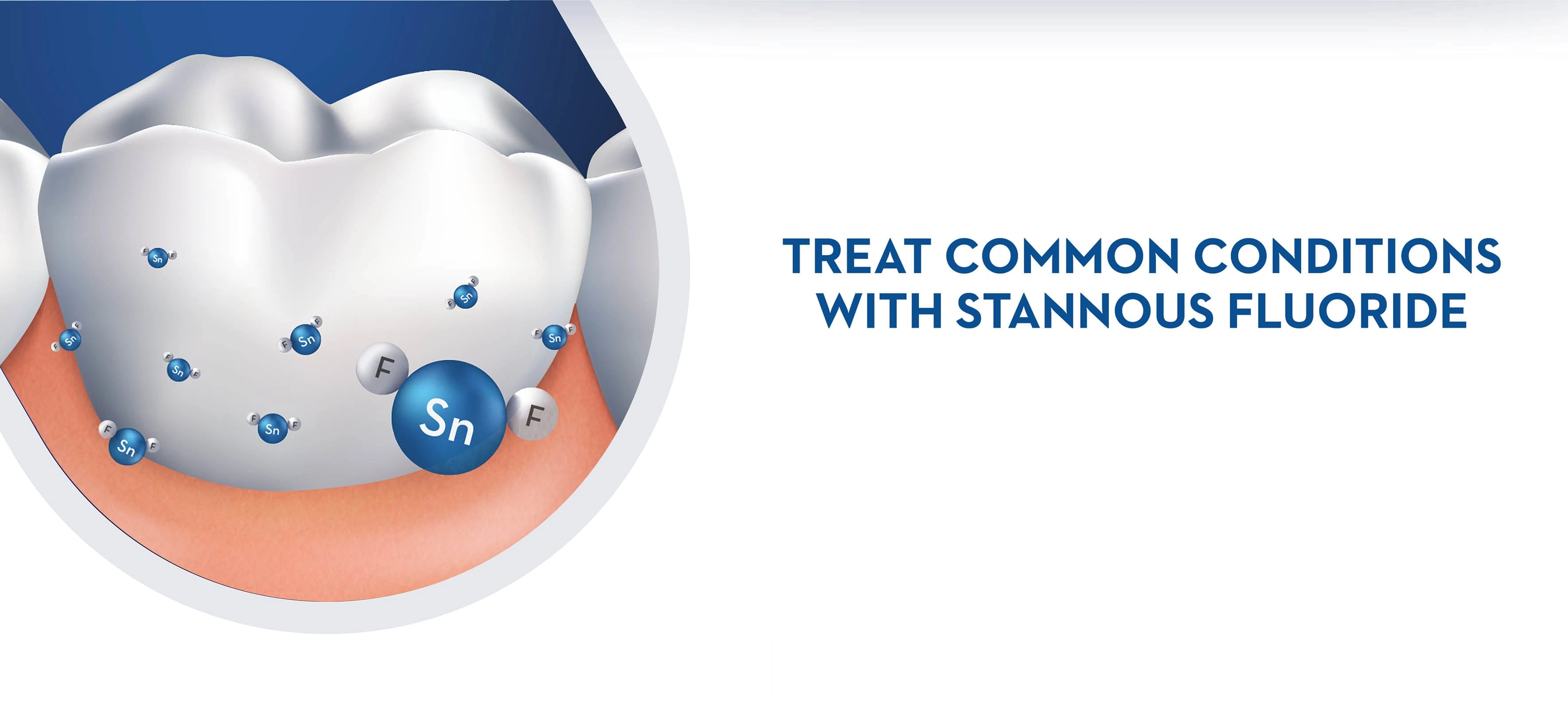 Treat Common Conditions with Stannous Fluoride