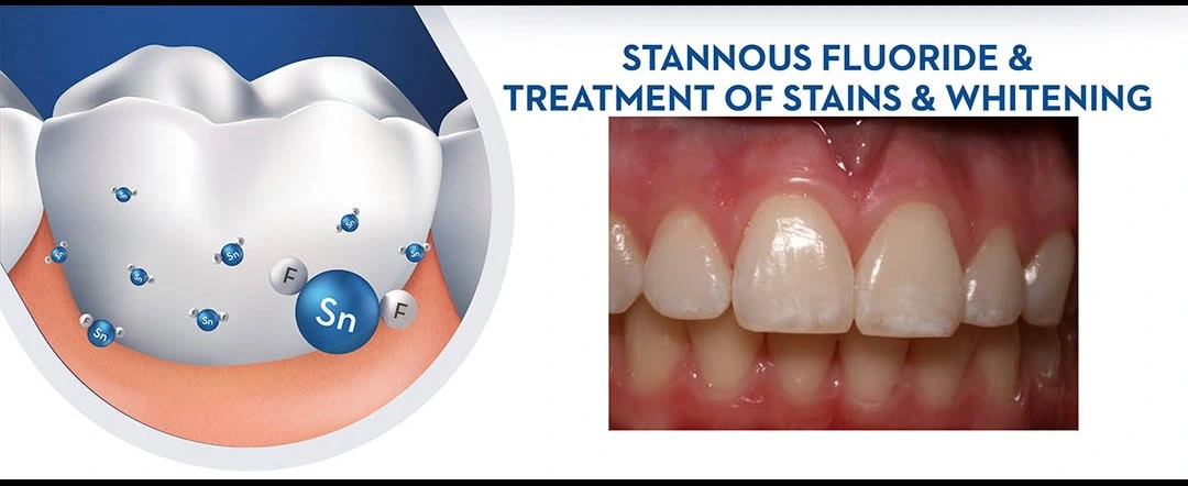 Stannous Fluoride  and Treatment of Stains and Whitening