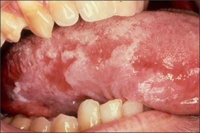Photo showing an example of oral cancer