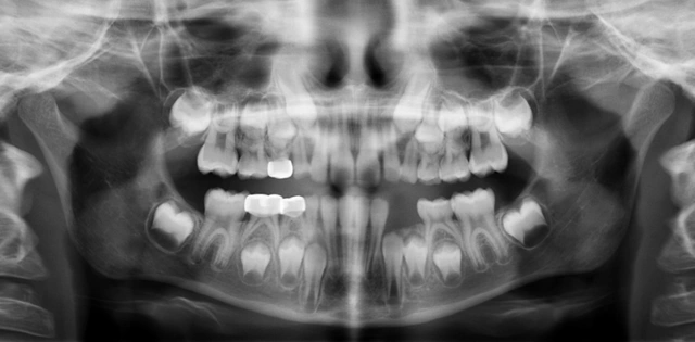 Panoramic Radiographs Radiographic Techniques For The Pediatric