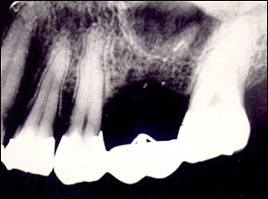 radiograph taken with vertical angulation of radiation beam