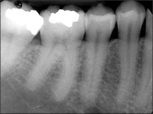 trabecular bone xray