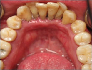 Photo showing mandibular view of teeth.