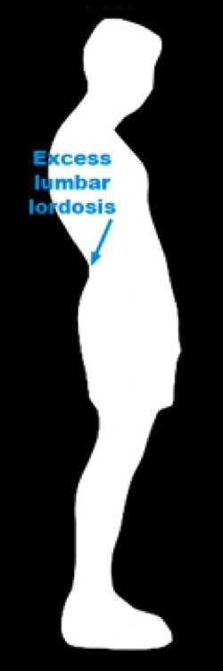 Image of swayback posture.