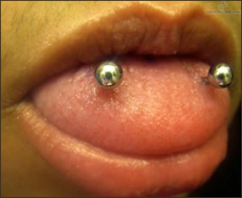 Image: Dorsolateral tongue piercing.