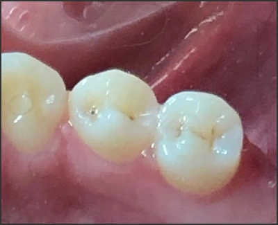 image of deep-occlusal fissures