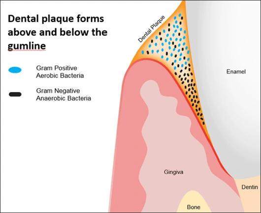 Illustration showing dental plaque forms above the gumline and in the gingival sulcus. 