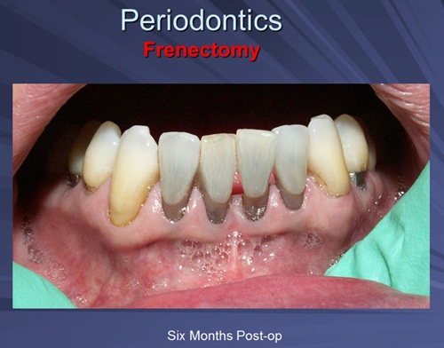 This image depicts six months post-operative view of an Er:YAG frenectomy.