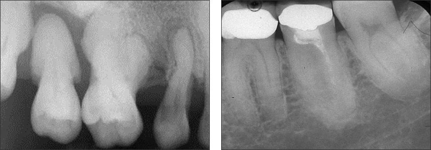 Periapical radiographs of several posterior teeth demonstrating hypercementosis