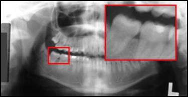 ce589 - Content - Features of an Ideal Panoramic Radiograph - Figure 8