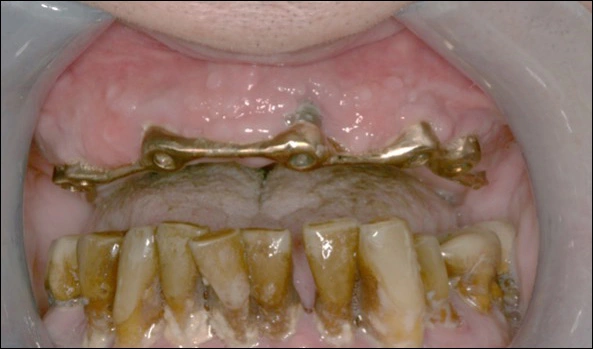 Photo showing Mucosal hyperplasia and mucositis in a bar supported prosthesis due to poor oral hygiene.