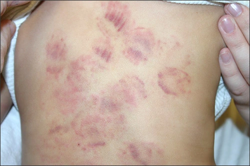 Photo showing a child with possible multiple bitemarks sustained from another child at a day care facility.