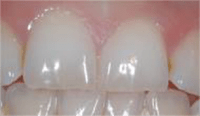 Photo of teeth with initial loss of surface texture