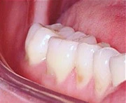 Image: Teeth showing tooth erosion.