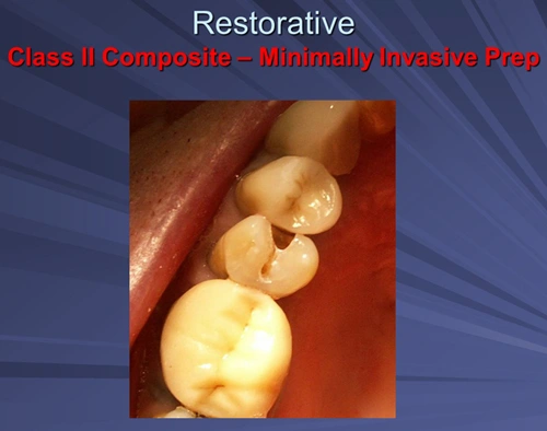 This image depicts a Class II Composite restoration preparation.