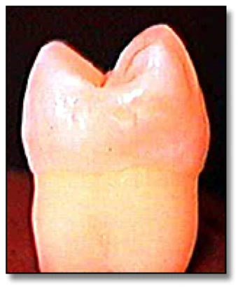 Photo showing extracted premolar with white spot as seen with white light