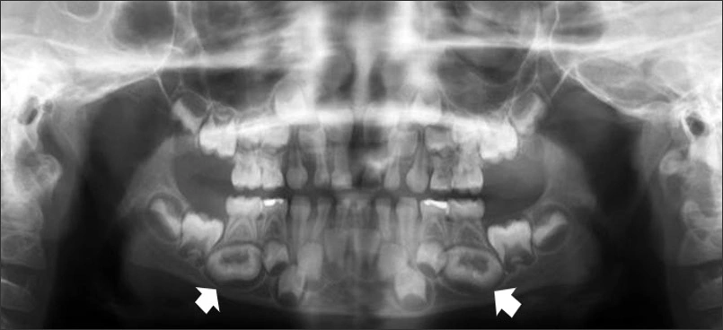 Panoramic radiograph with developing dilated odontomes of mandibular premolar teeth #20 & #29