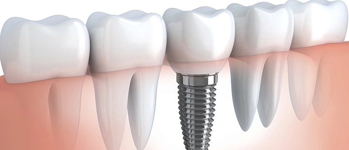 Practice Management - Case Acceptance - Implants - Content - Figure 1