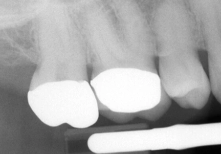 Radiograph showing periapical maxillary apices cut off