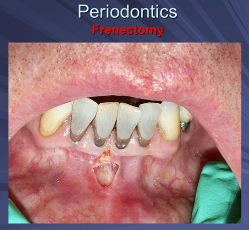 This image depicts immediate post-operative view of Er:YAG frenectomy.