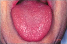 Erythematous mandibluar alveolar mucosa