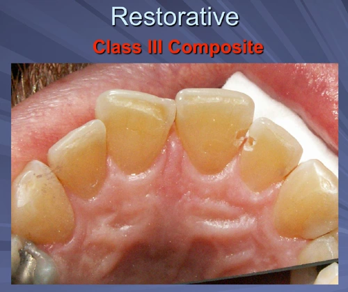This image depicts a Class III Composite restoration with teeth prepared without anesthesia by Er,Cr:YSGG laser.