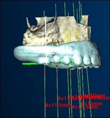 Photo showing implants planned parallel to each other.
