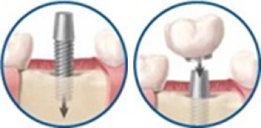 ce542 - Content - Implants - Figure 1