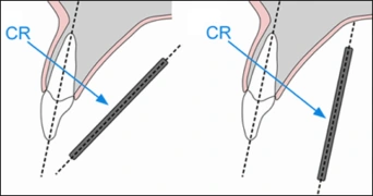 receptor angular and beam under-angulated examples