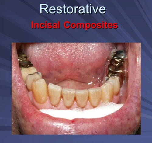 This image depicts incisal composites final restoration.