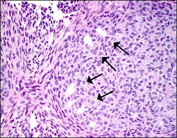 Case Challenge 29 - Content - Diagnostic Information - Figure 4 photomicrograph-med2