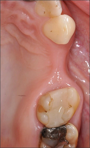 Additive Techniques - Alveolar Ridge Preservation and Augmentation for ...