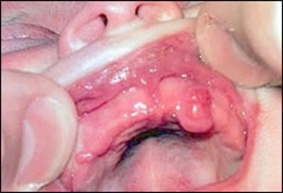 Image: Congenital epulis