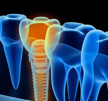 Caring for your dental implants