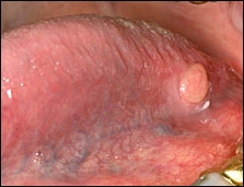 Case Challenge 34 - Content - Diagnostic Information - Figure 1 tongue nodule