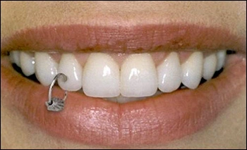 Photograph showing a tooth piercing.