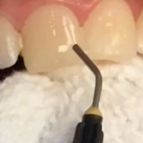  Anterior Resin Infiltration: A Minimally Invasive Treatment Option for Enamel Caries and Cosmetic Defects (ce634) - Introduction