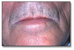 Image: Angioedema characterized by localized, well-circumscribed, non-pitted swelling affecting the lips.
