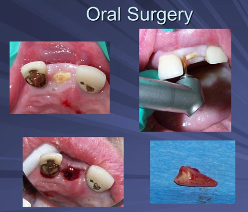 This image depicts a fractured crown on tooth number 9. The Er:YAG is used in a flapless approach to resect bone and make space in the periodontal ligament for judicious elevation.