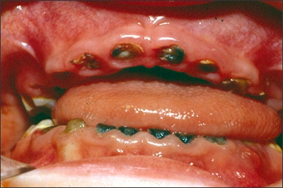 ce387 fig12 Late  or severe form of ECC