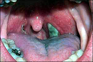 asymmetrical tonsils
