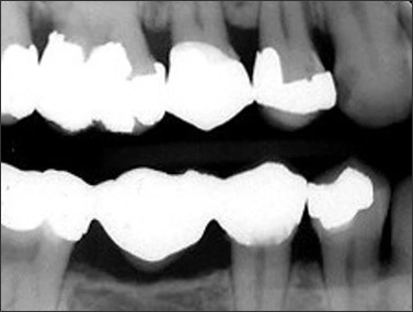 Normal Radiographic Appearance of the Supporting Structures of the Teeth - Figure 5