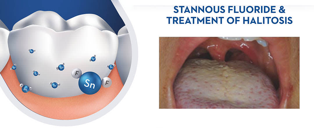 stannous fluoride canker sore