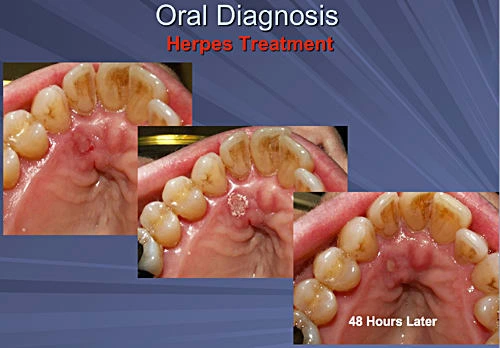 This image depicts a series of three photos showing the healing process over 48 hours of a palatal herpes type I outbreak.