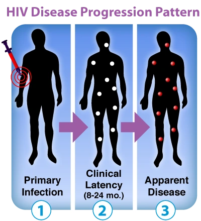 Image: HIV disease progression pattern.